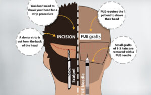 Explain The Difference Between FUT And FUE Hair Transplant