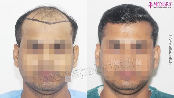 Is Hair Transplant The Most Effective Treatment For Alopecia Areata