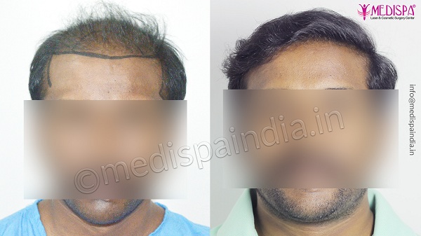 How To Get Safe Hair Transplant Treatment For Hair Loss Issue