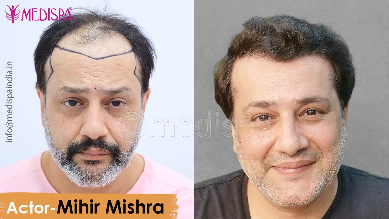 celebrity hair transplant 