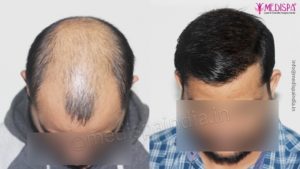 How To Know About Grade of Baldness And How Hair Transplant Can Help?