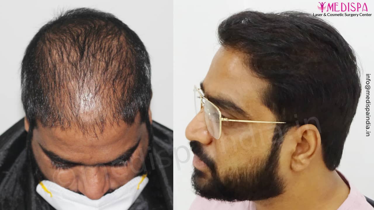 Best India Hair Transplant Results