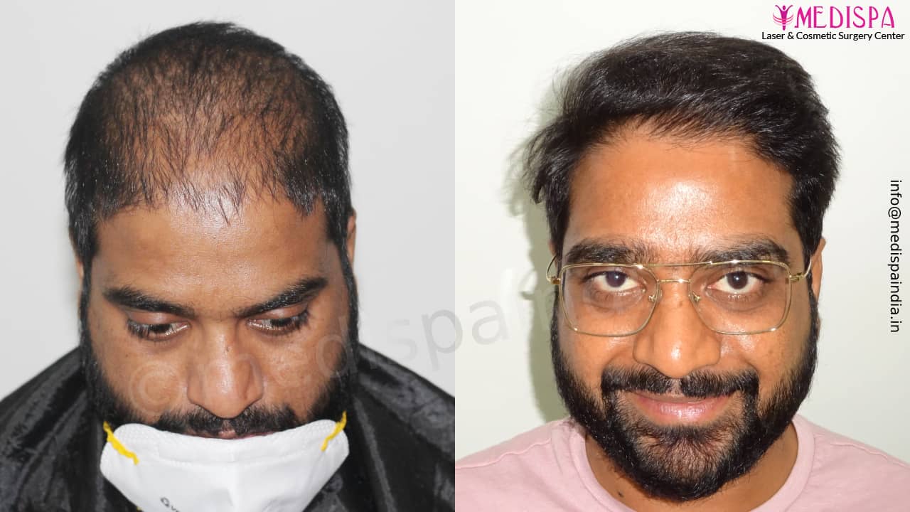 Jaipur hair transplant