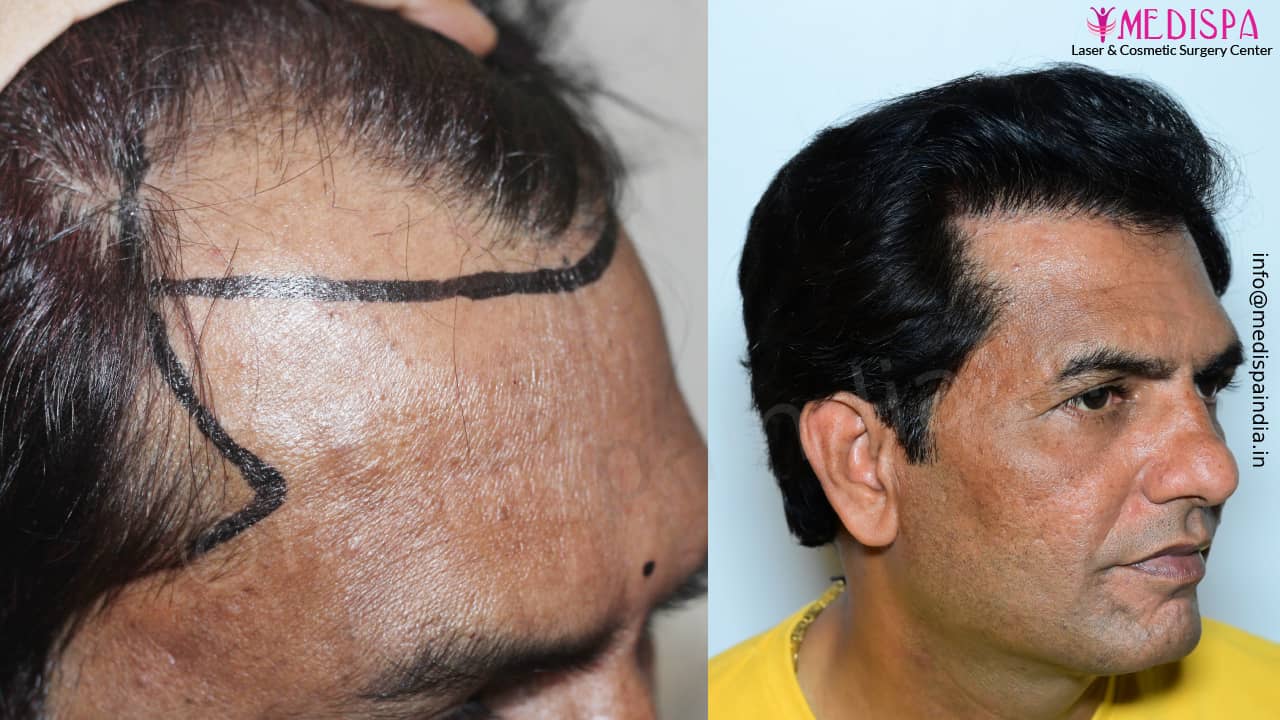 hair transplant doctor