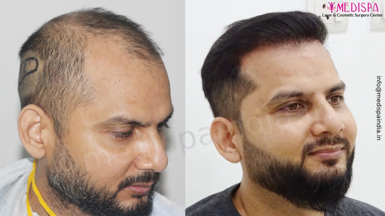 hair transplant in delhi