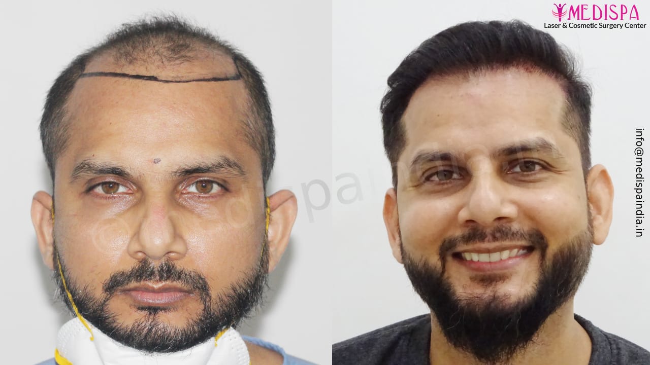 hair transplant in india