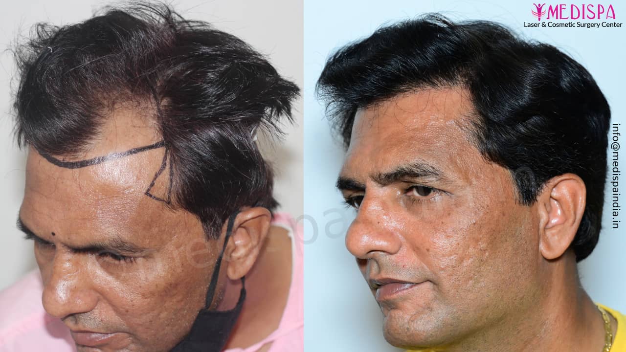 hair transplant surgeon