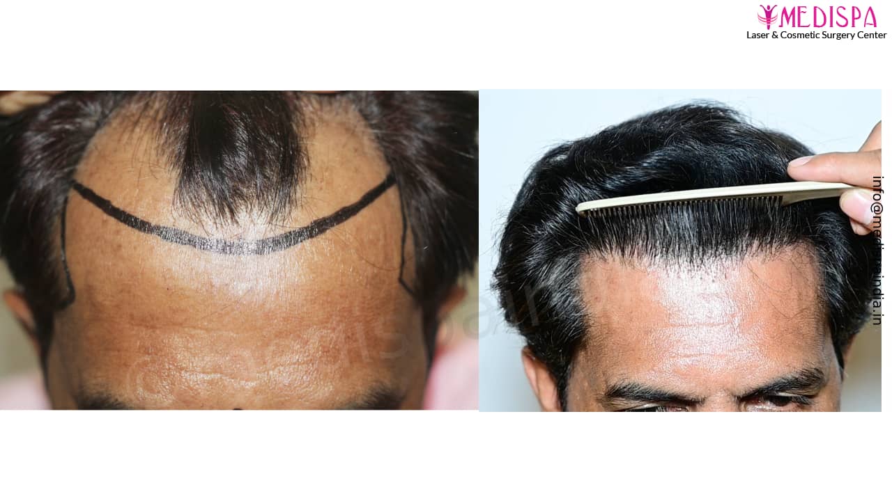 hair transplant