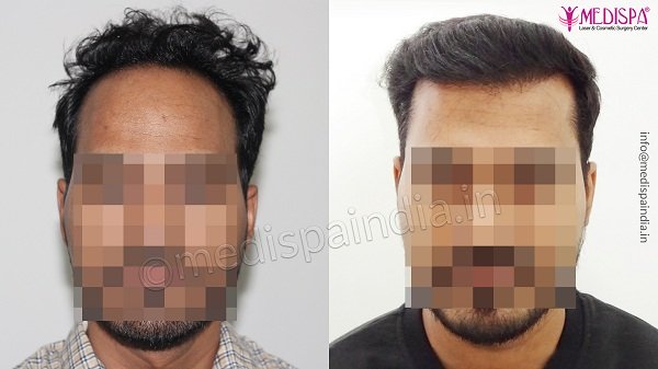 3100 Grafts Hair Transplant Case Study  Expert Hair Transplant  Hair  Transplant Case Studies By Expert Hair Transplant