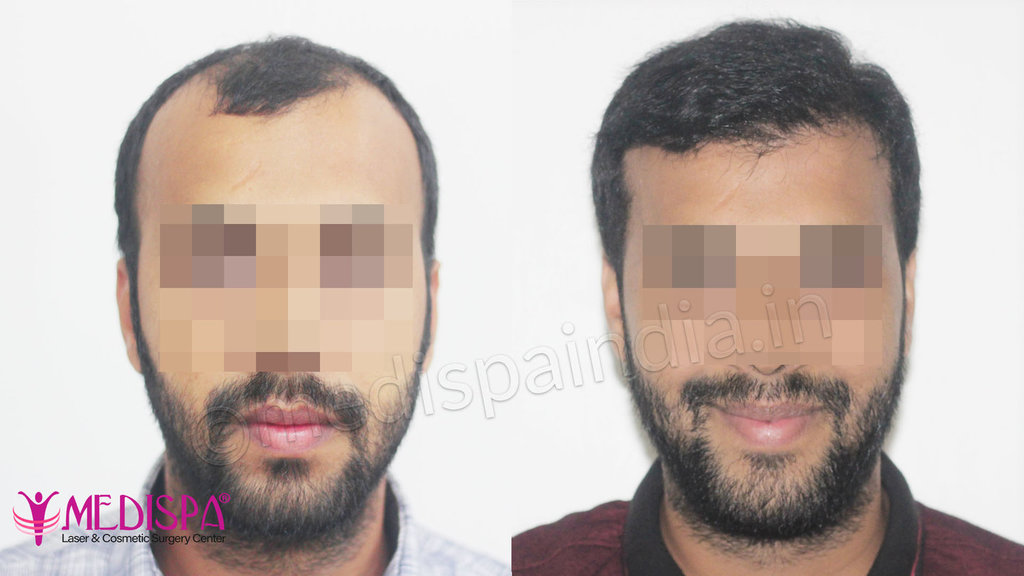 hair transplant in Ajmer