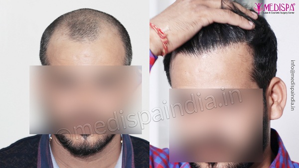 Explain The Stages of Baldness And How Hair Transplant Can Help?