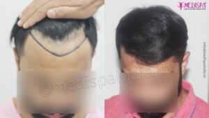 What Are The Precautions Need To Be Taken Pre And Post Hair Transplant?