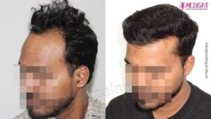 Explain The Hair Transplant Process From Start To End