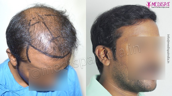 Explain The Hair Transplant Process From Start To End