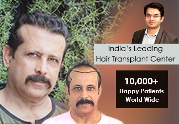 Hair Transplant in Jaipur, Rajasthan | Best Hair Transplant Clinic