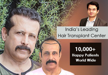 hair transplant in Jaipur