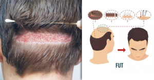 Things To Consider Before Undergoing FUT Hair Transplant