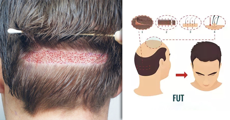 Explain The Importance Of FUT Method For Hair Transplant