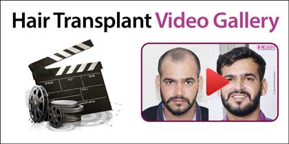 hair transplant cost