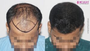 Is Hair Transplantation A Painless Surgical Procedure?