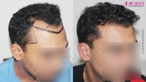 What Are The Safety Protocols And Practices For Hair Transplant?