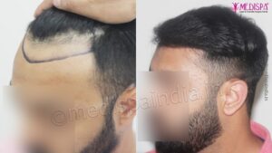 Factors That Determine Appropriate Hair Transplant Technique