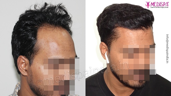 Is Hair Transplant A Painless Surgical Procedure?