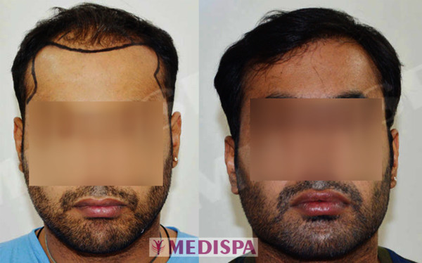How To Know About The Number of Grafts Required For Hair Transplant Surgery?
