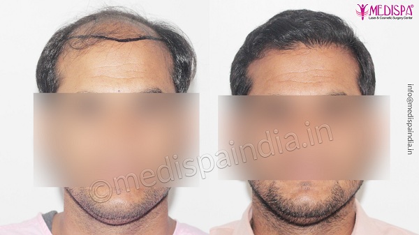 Why Should You Consider Hair Transplantation For Pattern Baldness?