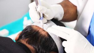 What Are The Common Myths And Facts About Hair Transplant?