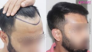 How To Get Cost Efficient Hair Transplant Treatment?