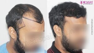 How Much Time It Takes To Get Visible Results After Hair Transplant?