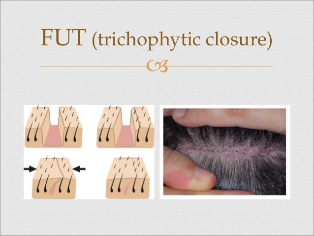 Explain The Significance of Trichophytic Closure in Hair Transplantation
