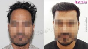 Suffering From Baldness Issue? How Hair Transplant Can Help?