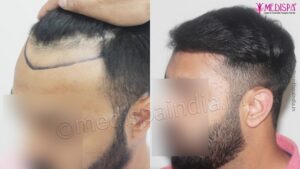 What Are The Primary Reasons For Undergoing Hair Transplant?