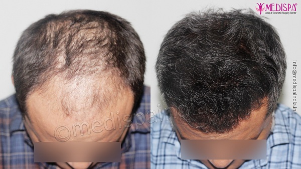 What is The Success Rate For Hair Transplant in Elderly?