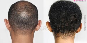 How Does Hair Transplant Help Curing The Issue of Hair Loss?