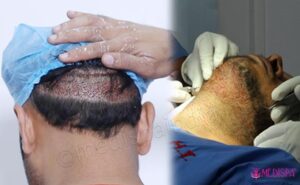 Explain The Qualities of A Good Hair Transplant Surgeon