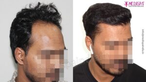 How Important is The Primary Consultation Before Hair Transplant?