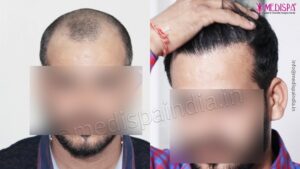 How To Take Care of The Donor Area After Hair Transplant?