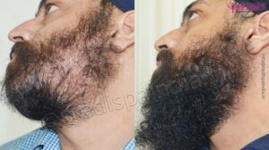 Everything To Need To Know About Beard Hair Transplant