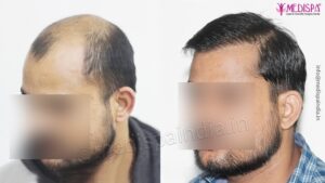 Explain The Success Rate of Hair Transplantation