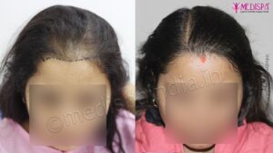 From Balding To Beautiful: The Success of Hair Transplant Surgery