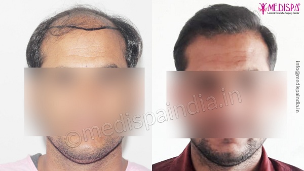 What To Expect Before, During, And After Hair Transplant Surgery