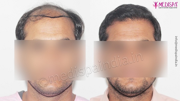 A Comprehensive Guide To Hair Transplant For Hair Loss Issue