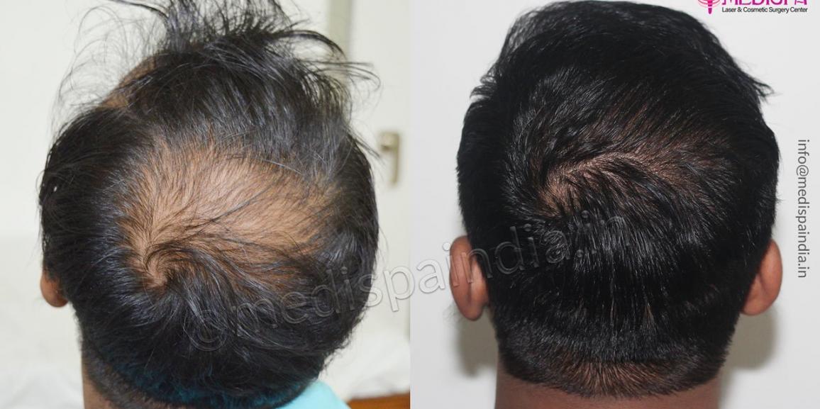 High Baldness? No Problem. Here’s How Hair Transplant Can Help