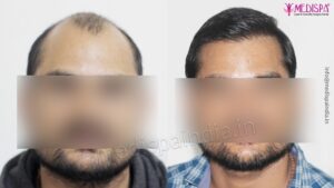 How To Know if Hair Transplantation is Suitable For Me?