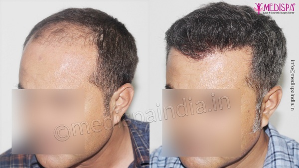 Key Factors To Consider While Choosing Hair Transplant Clinic