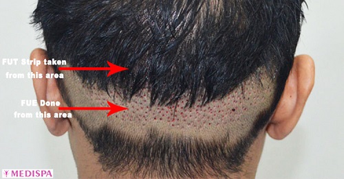 Is FUT+FUE+BHT Combination Hair Transplant Technique Really Effective?