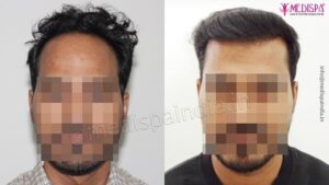 How To Prepare For A Hair Transplant Procedure